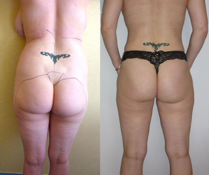 resultat-lifting-cuisses-tunisie