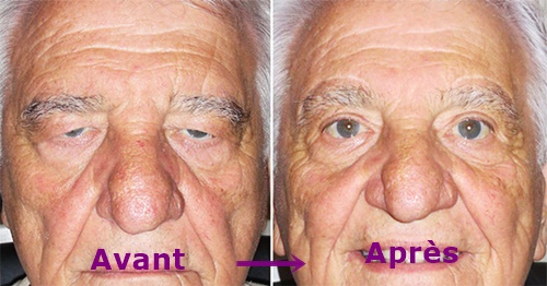 blepharoplastie avant apres