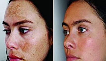 peeling moyen photo avant apres