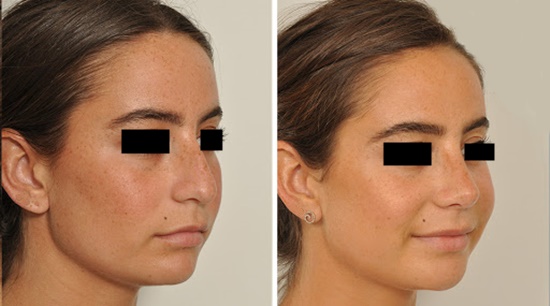 rhinoplastie avant apres