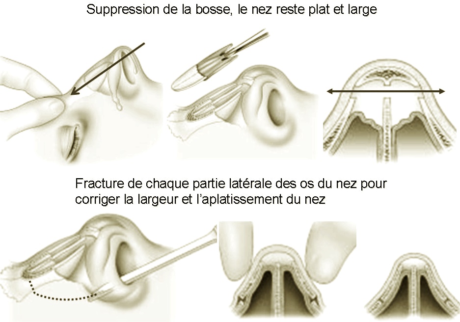rhinoplastie tunisie : technique