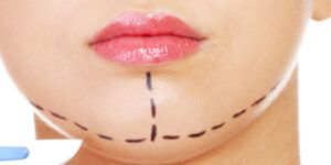 Genioplastie Tunisie